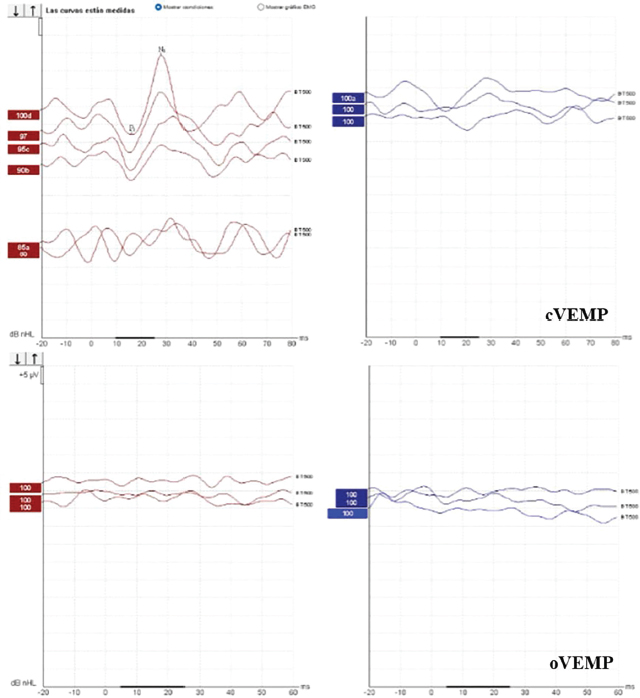 Figura 3. VEMP iniciales